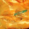 Vorhofseptumdefekt (ASD) und Offenes Foramen ovale (PFO)