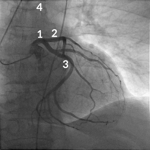 Koronar-Angiographie