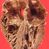 Herzmuskel