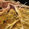 Angina Pectoris