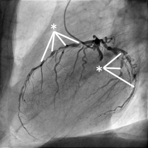 Koronarangiographie: Mehrere hochgradige Einengungen (*) eines Herzkranzgefässes bei einem Patienten mit Angina pectoris